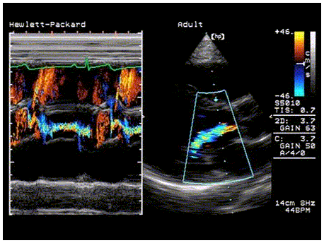 Herz Ultraschall mit Doppler